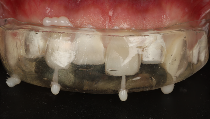Close-up of upper front teeth with a transparent dental appliance covering them and small white material drops on the appliance