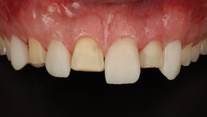 Close-up of upper front teeth showing one central incisor with a large chip and discoloration