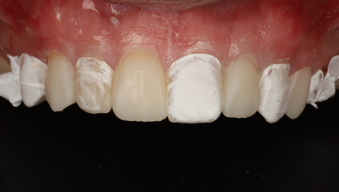 Close-up of upper front teeth with white dental material applied unevenly on several teeth and gums visible above
