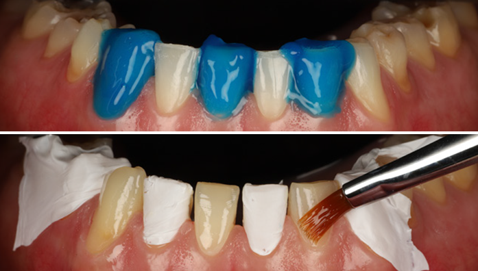 Close-up of upper front teeth with blue dental material applied on some teeth in the top half and a brush applying a substance to the teeth in the bottom half