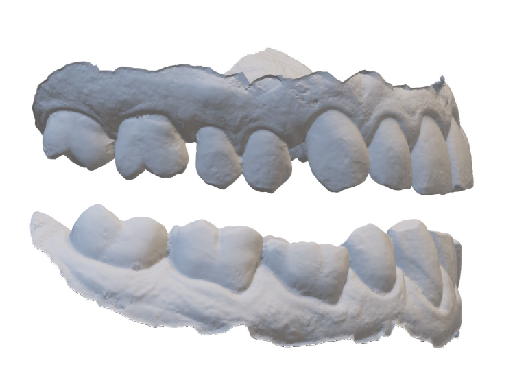 3D dental model showing upper and lower teeth arches