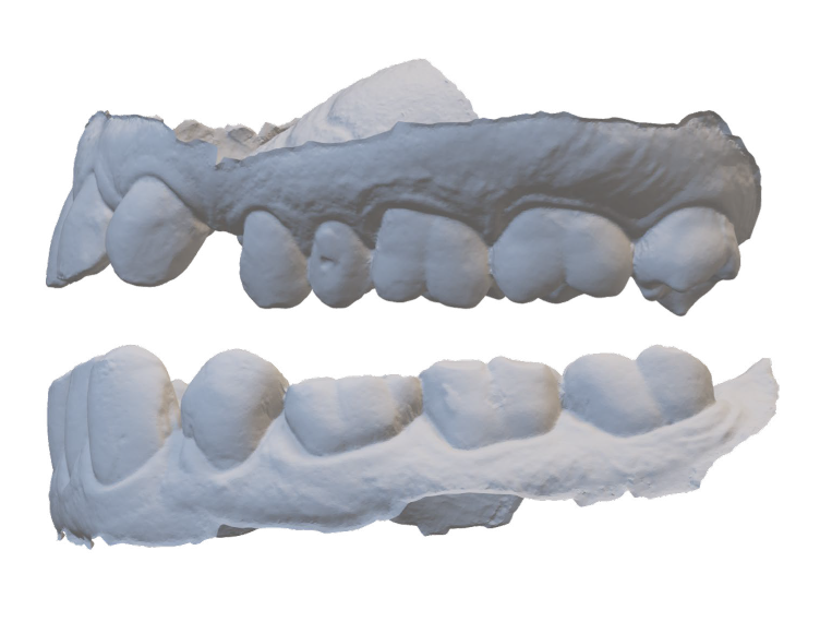 Dental plaster model showing upper and lower teeth in occlusion