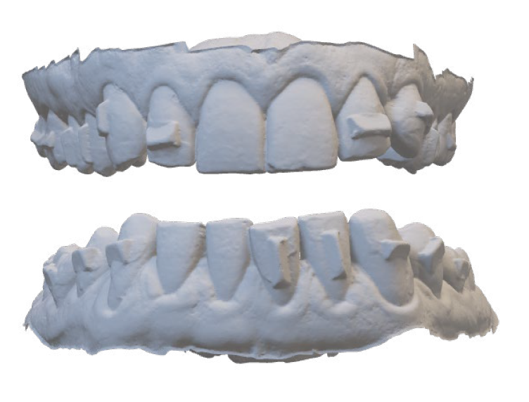 Dental plaster model showing upper and lower teeth with several teeth missing or damaged