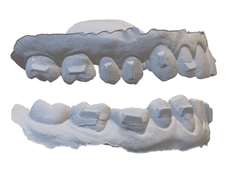 3D dental model showing upper and lower teeth with orthodontic brackets attached