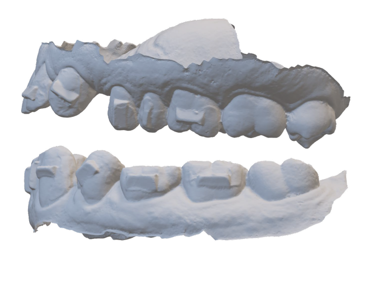 Dental plaster model showing upper and lower teeth with orthodontic brackets attached