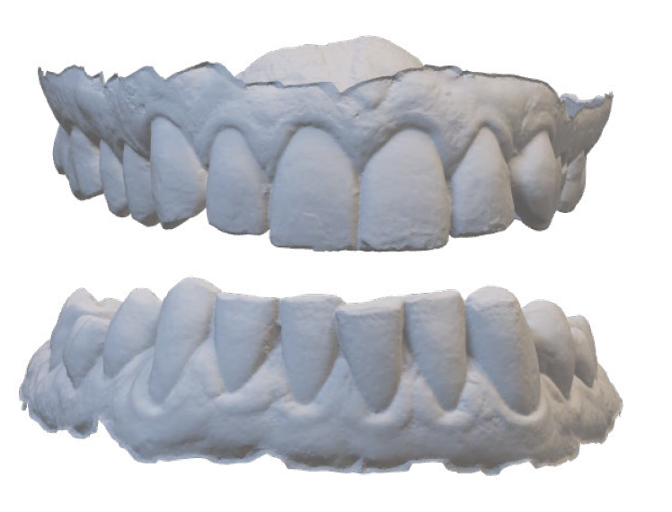 Plaster dental molds showing upper and lower teeth with detailed tooth shapes and gum contours