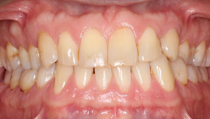 Close-up of upper and lower teeth with visible dental plaque and slight misalignment