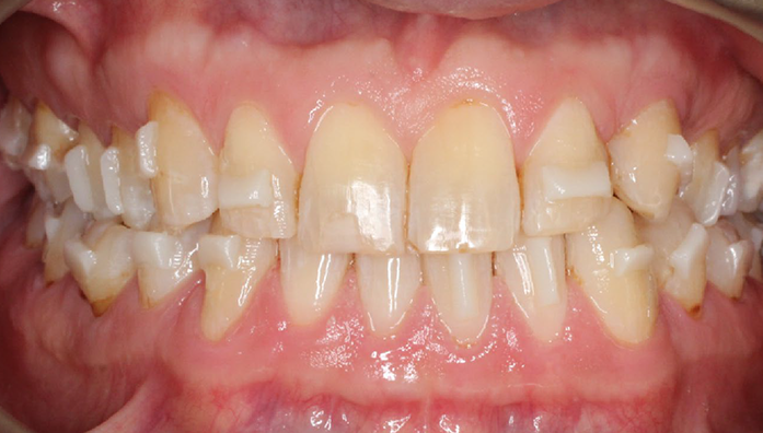 Close-up of upper and lower teeth showing dental misalignment and crowding