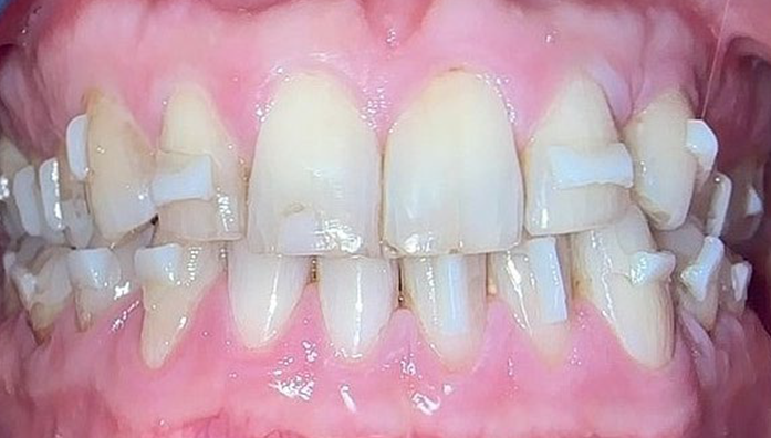 Close-up of upper and lower teeth with clear dental aligners fitted