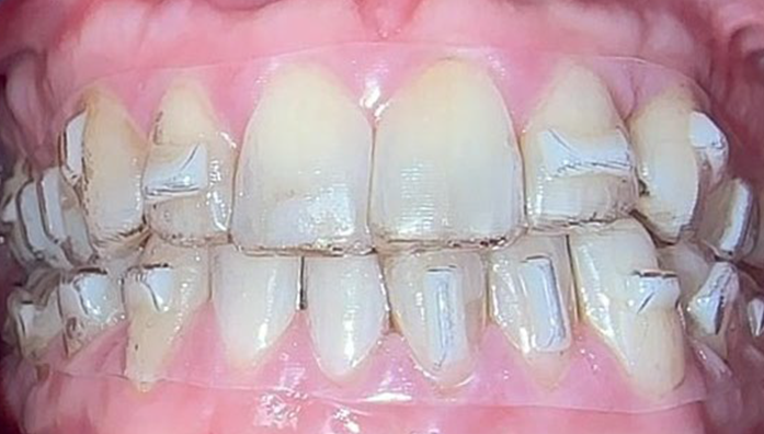 Close-up of upper and lower teeth with clear dental aligners fitted