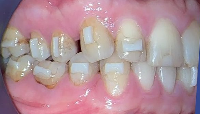 Close-up of lower and upper teeth with multiple white dental attachments on several teeth