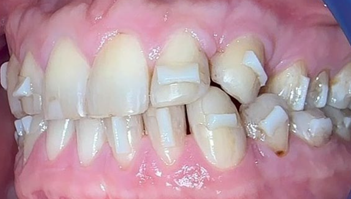 Close-up of teeth with multiple small white dental wedges placed between them