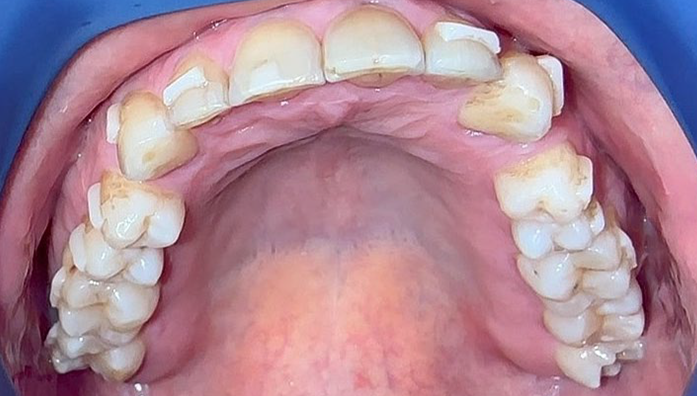 Upper jaw with multiple teeth showing wear and discoloration