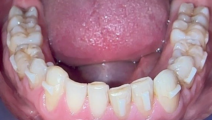 Lower jaw with natural teeth showing wear and discoloration