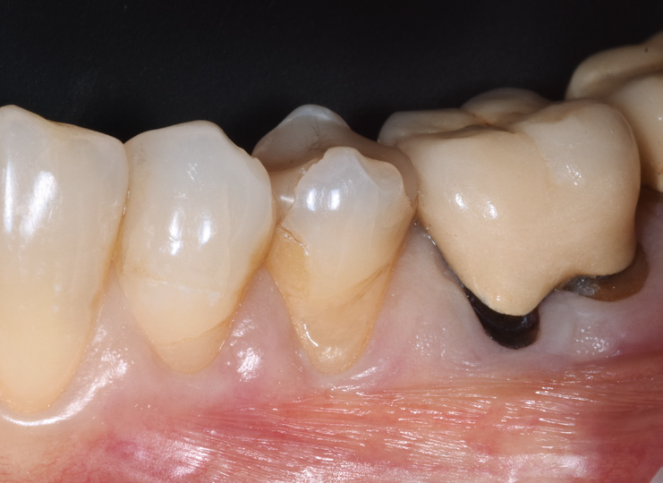 Close-up of lower molars showing a tooth with a large cavity and surrounding gum tissue