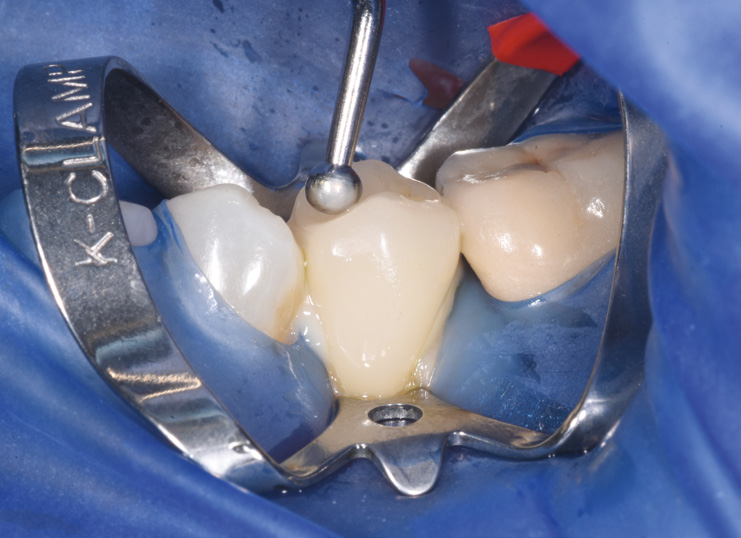 Close-up of three teeth isolated with a dental rubber dam and metal clamp during a dental procedure