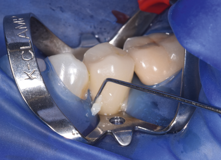 Close-up of dental procedure with metal clamp and dental instruments on molars isolated by blue rubber dam
