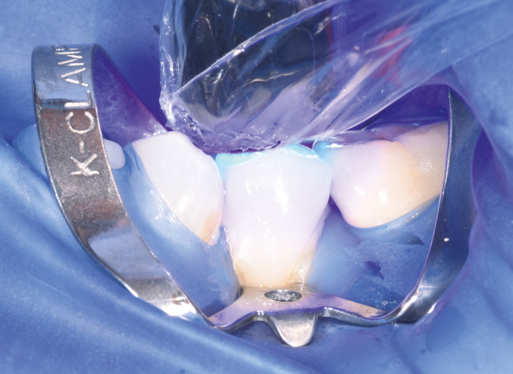 Close-up of two teeth isolated with a dental rubber dam and metal clamp during a dental procedure