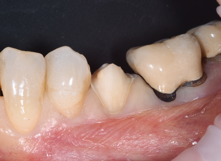 Close-up of lower molars and premolars with one tooth restored by a dental crown showing metal margins