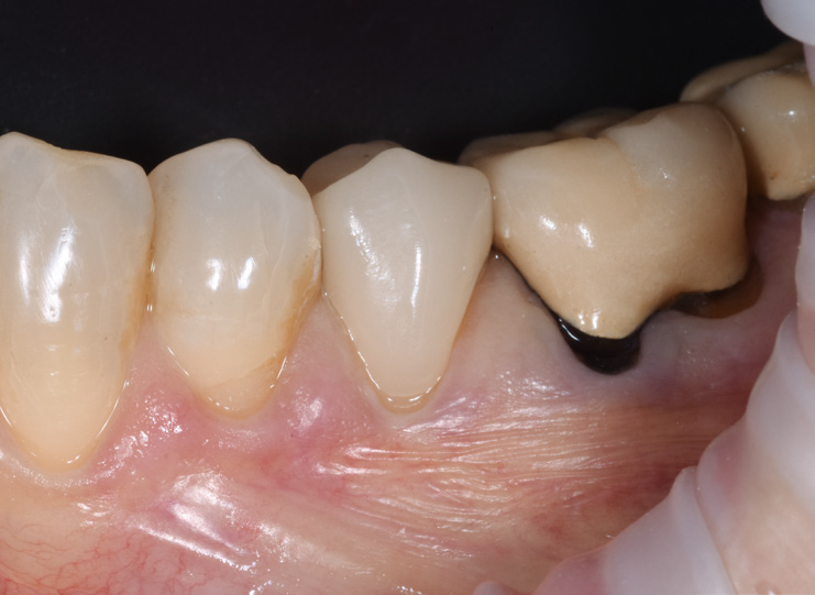 Close-up of lower molars and premolars with dental crown on one molar and visible gum tissue