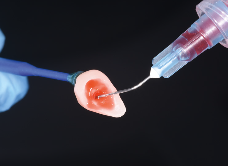 Close-up of a dental tool holding a pink dental mold with a small cavity being treated by a syringe-like instrument