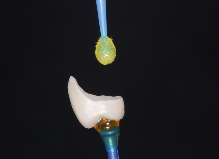 Dental implant abutment with a dental crown above a blue-handled applicator with a yellow foam tip