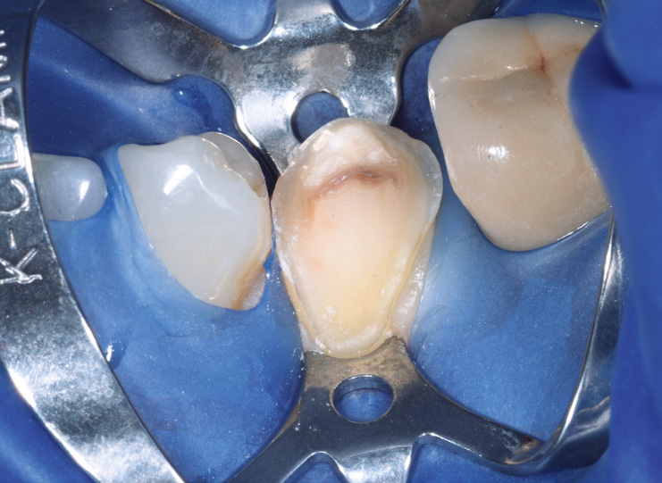 Close-up of a tooth prepared for dental restoration with a metal dental dam clamp and blue rubber dam isolating adjacent teeth