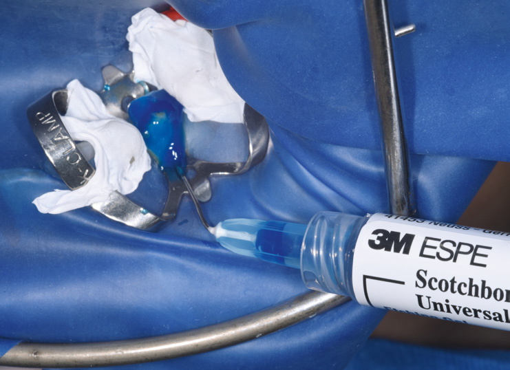 Dental rubber dam with metal clamp and syringe applying