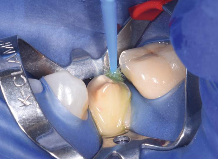 Close-up of dental procedure with rubber dam and clamp isolating a tooth being cleaned with a rotating brush tool