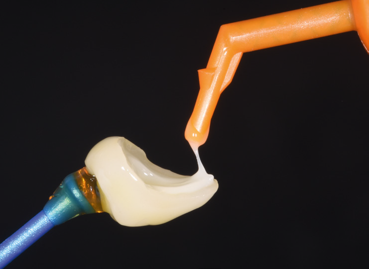 Dental crown held by a blue-handled tool with white dental cement being applied from an orange applicator tip