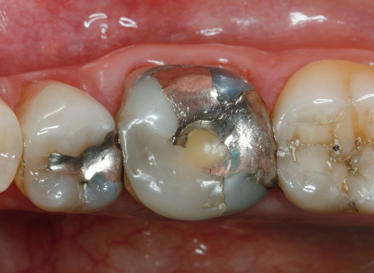 Close-up of three molars showing dental restorations with metal fillings and visible tooth decay on the middle tooth