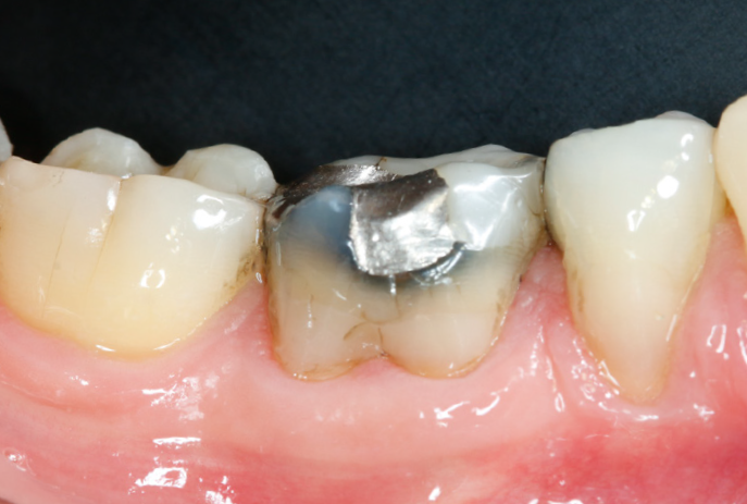 Close-up of lower molars showing a metal dental filling on one tooth surrounded by natural teeth and pink gums