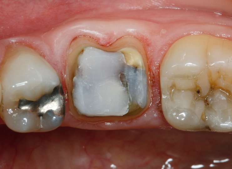 Close-up of upper molars showing a tooth with a large white filling and adjacent teeth with metal and composite restorations