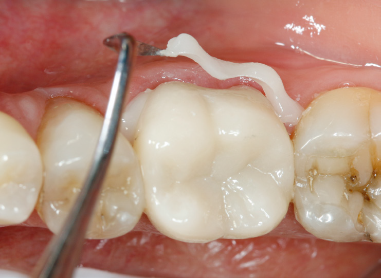 Close-up of molars with dental tool and white dental material on gum above a tooth
