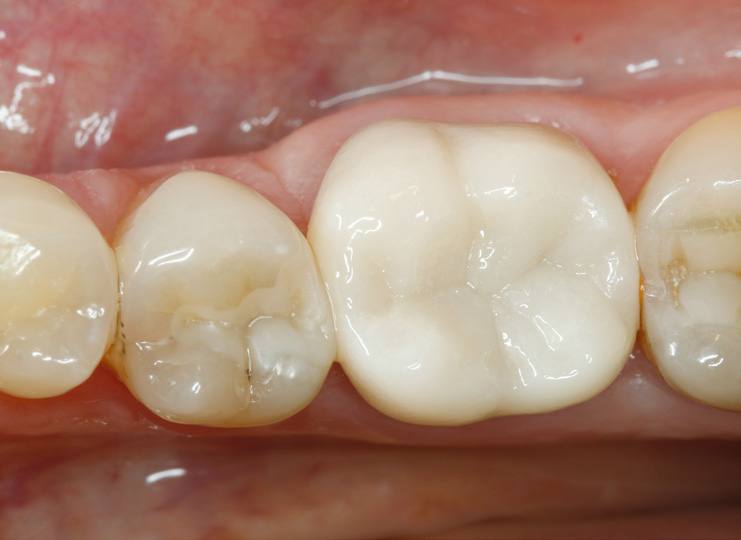 Close-up of lower molars showing one tooth with a dental crown and adjacent natural teeth