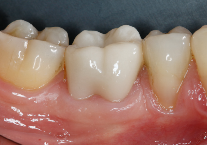 Close-up of lower molars and premolars with healthy gums